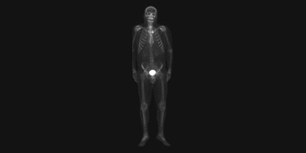 Bone Scan