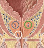 Three implanted BeaconÂ® 电磁转发器 within the prostate